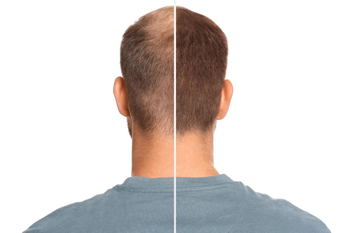 Oral Minoxidil Before and After: What Real Results Look Like